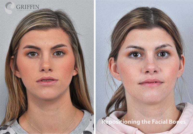 Before and after front views showing facial bone repositioning to refine facial contours and improve symmetry.