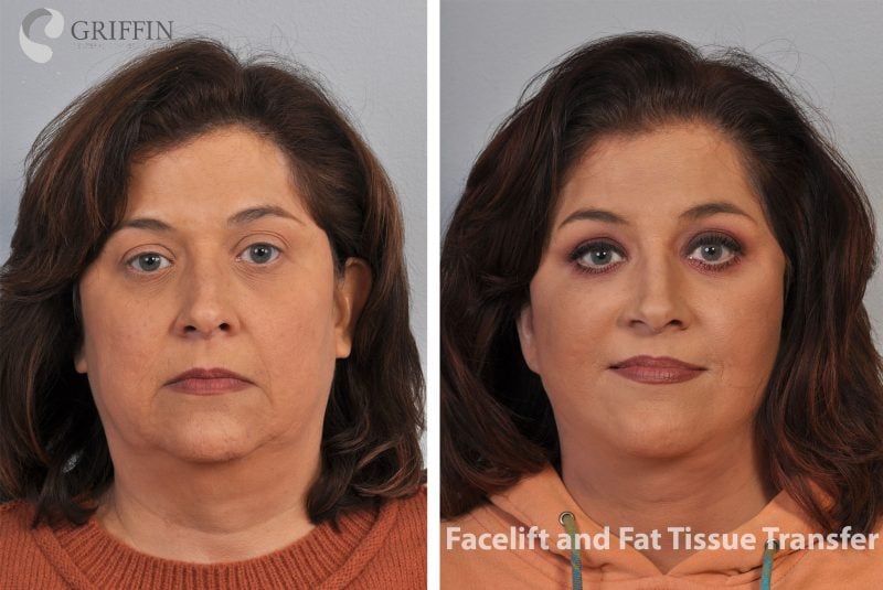 Before and after front views showing facelift and fat tissue transfer restoring facial volume and reducing sagging for a youthful contour.