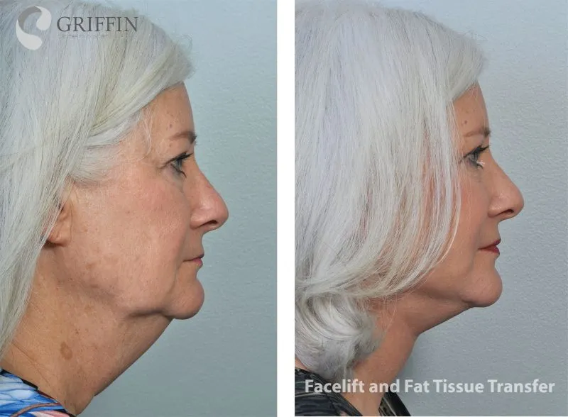 Before and after profile comparison of facelift and fat tissue transfer demonstrating improved jawline, neck angle, and facial harmony.
