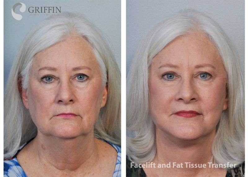 Before and after front views showing facelift and fat tissue transfer results with restored facial volume and youthful contours.