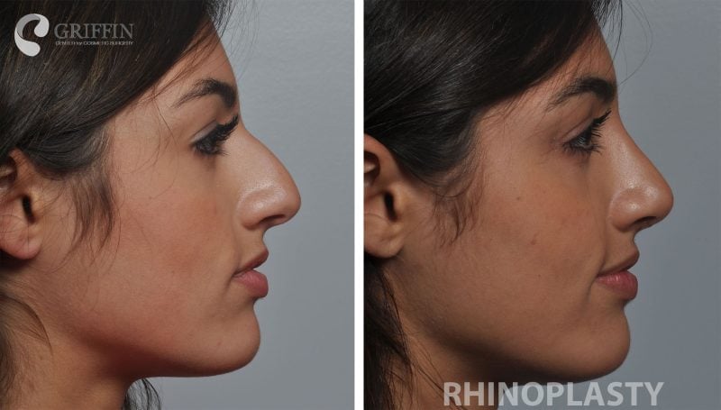 Before and after profile views of rhinoplasty surgery refining the nose bridge and tip for a balanced facial profile.
