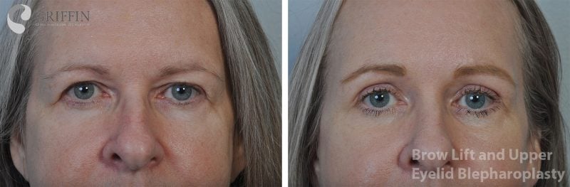 Before and after close-up front views of brow lift and upper eyelid blepharoplasty revealing brighter, more open eyes.
