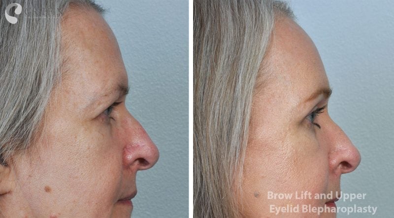 Before and after profile comparison of brow lift and upper eyelid blepharoplasty showing improved eye area aesthetics.