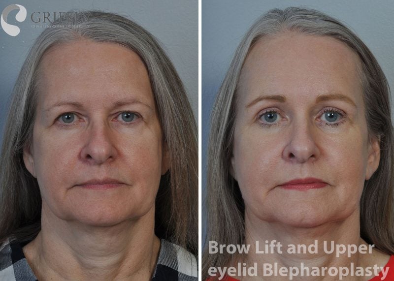 Before and after comparison showing brow lift and upper eyelid blepharoplasty lifting heavy brows and removing excess eyelid skin.