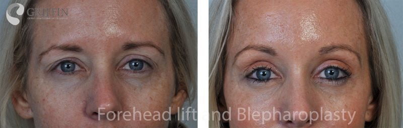 Before and after close-up comparison of forehead lift and blepharoplasty creating a smoother forehead and refreshed eye area.