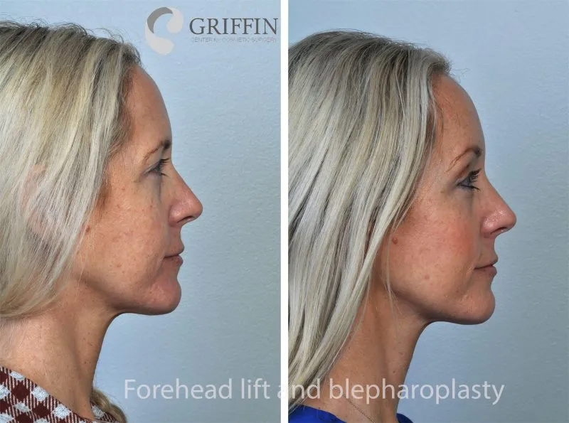 Before and after profile comparison showing forehead lift and blepharoplasty results for a more youthful eye and forehead appearance.