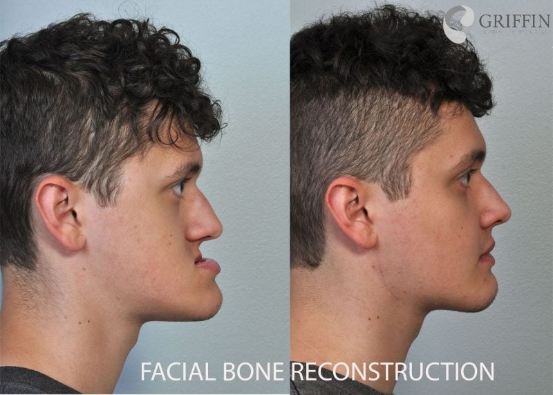 Before and after profile smiling comparison of facial bone reconstruction showing harmonious facial proportions and enhanced definition.