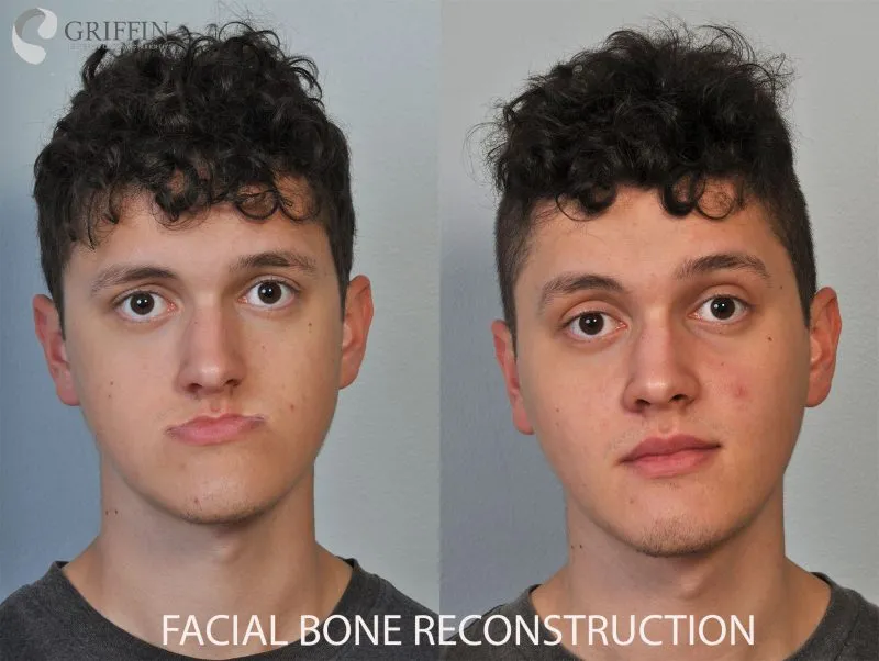 Before and after front neutral expression showing facial bone reconstruction results with improved facial symmetry and structure.