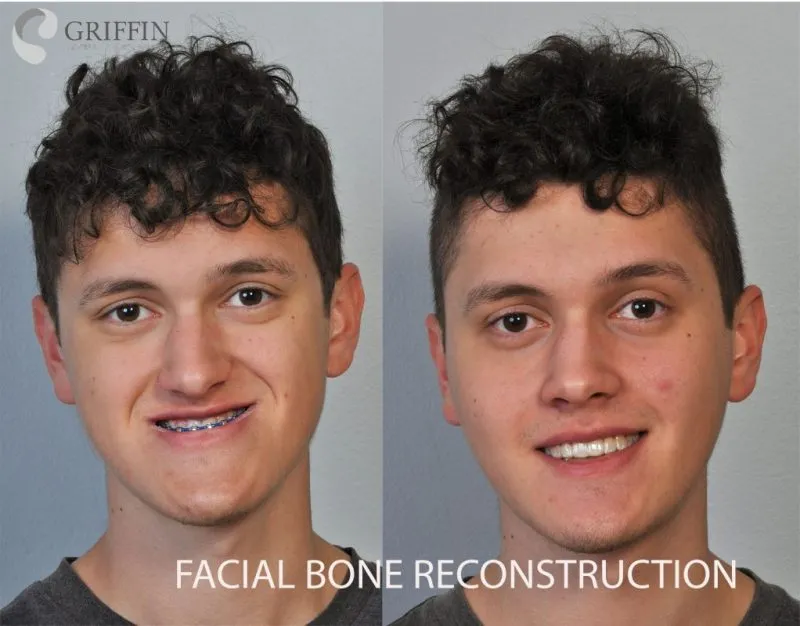 Before and after front smiling view of facial bone reconstruction showing enhanced facial balance and natural-looking results.