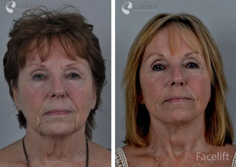 Before and after front views of facelift surgery demonstrating lifted facial tissues, reduced sagging, and refreshed appearance.