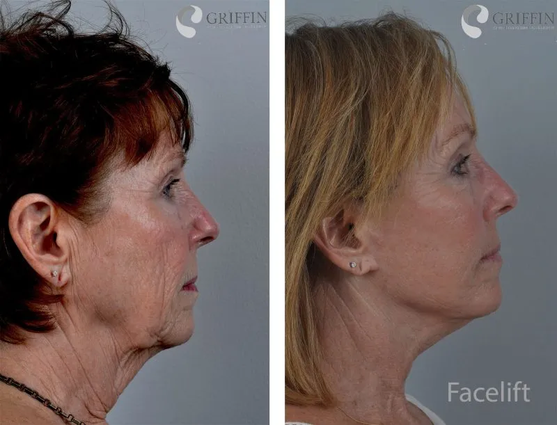 Before and after profile views of facelift procedure showing improved jawline, reduced jowls, and smoother neck contour.