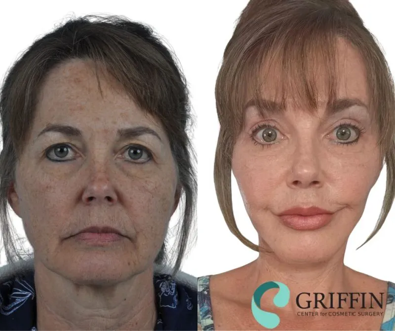 Before and after front views demonstrating facelift results with reduced sagging, smoother skin, and more youthful facial contours.