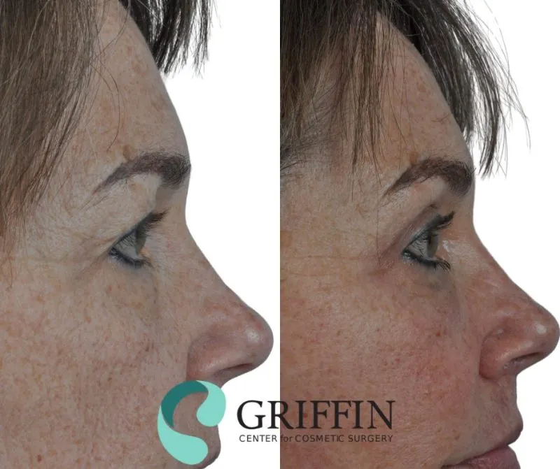 Before and after profile comparison showing rhinoplasty results with refined nose bridge and tip projection.