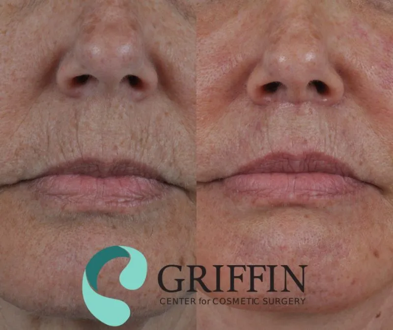 Before and after profile comparison showing rhinoplasty results with refined nose bridge and tip projection.
