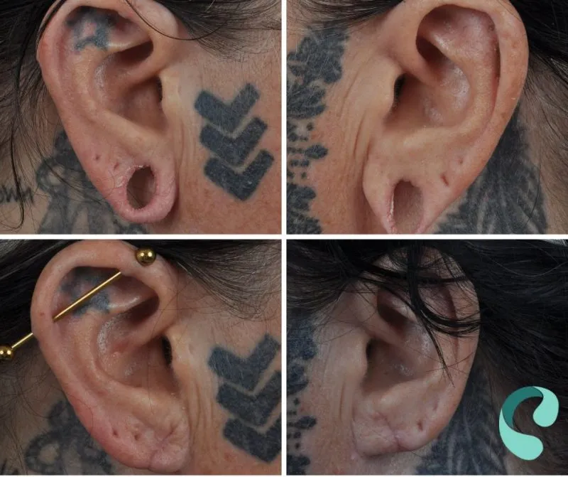 Before and after images of ear reconstruction correcting ear shape and structure with visible tattoo coverage.