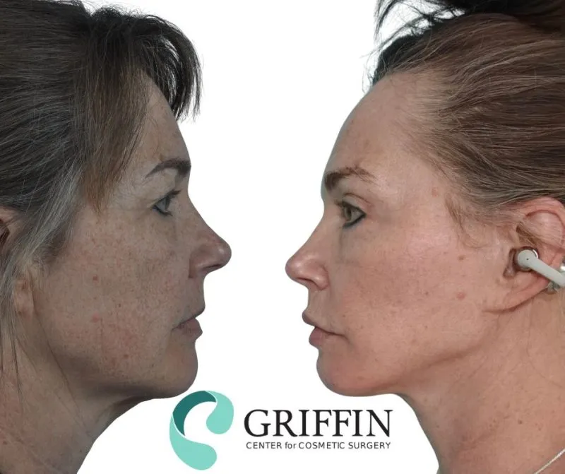 Before and after profile views showing facial rejuvenation with improved jawline definition and neck contouring at Griffin Center for Cosmetic Surgery.